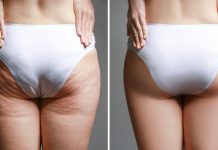 Masaj pentru eliminarea celulitei